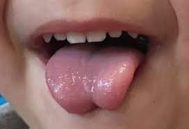 LEARN MORE - Tongue Tie Life
